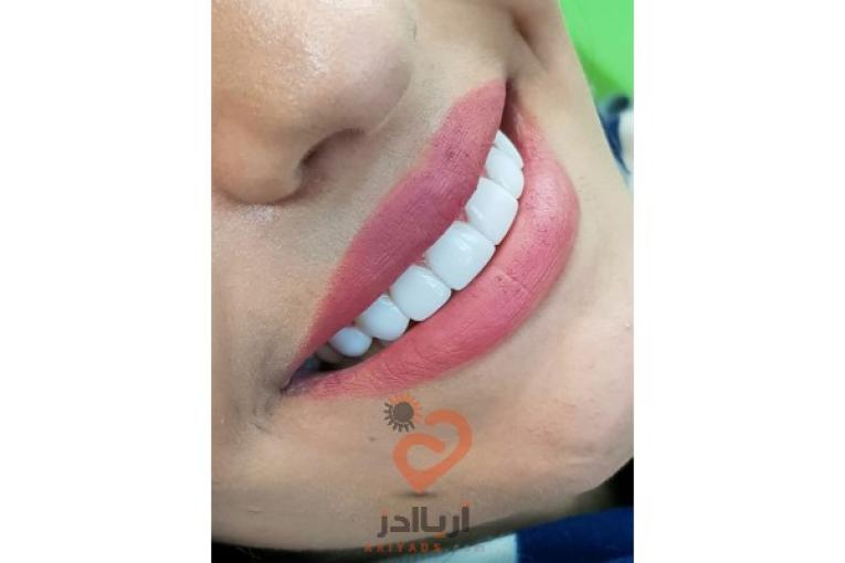 ایمپلنت و زیبایی ،( اقساط)