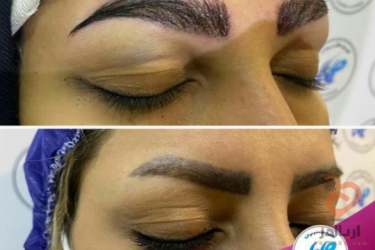 کاشت ابرو مناسب افرادی که ابروهای کم پشتی دارند