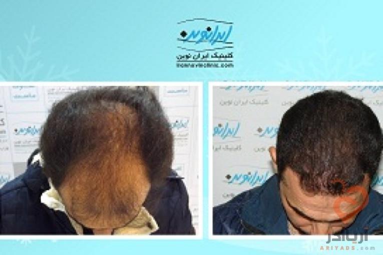 "کاشت مو در ایران نوین تنها با دو و نیم میلیون تومان"