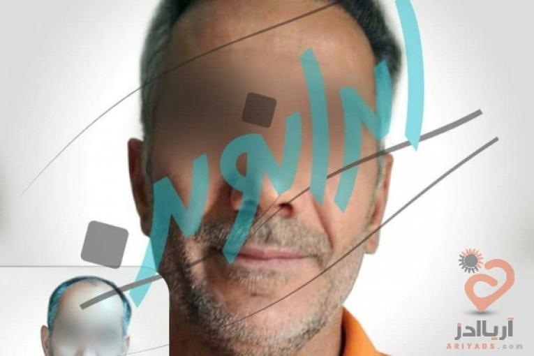 "کاشت مو در ایران نوین تنها با دو و نیم میلیون تومان"