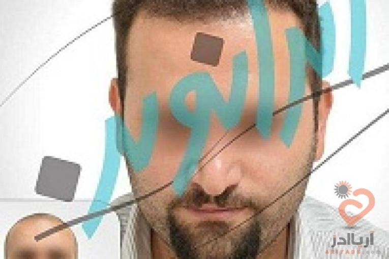 "کاشت مو در ایران نوین تنها با دو و نیم میلیون تومان"