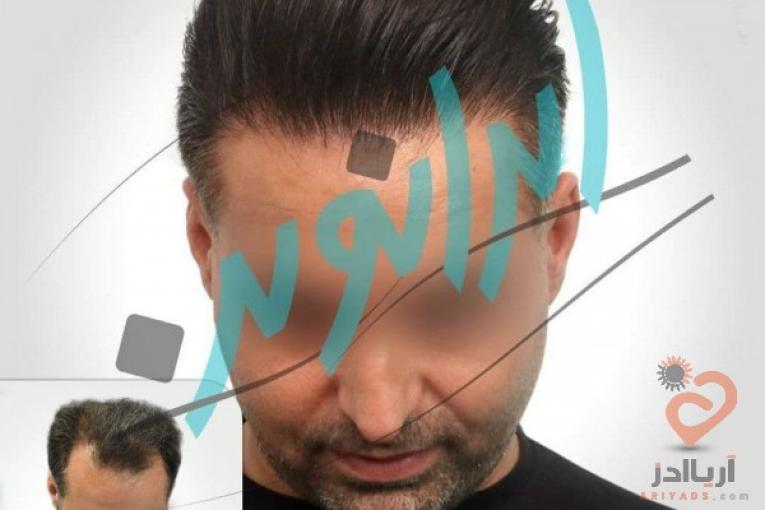 "کاشت مو در ایران نوین تنها با دو و نیم میلیون تومان"