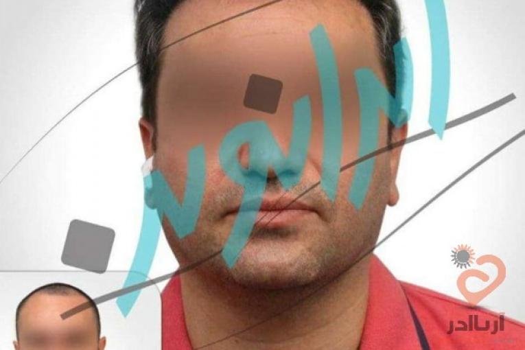 "کاشت مو در ایران نوین تنها با دو و نیم میلیون تومان"