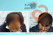 "کاشت مو در ایران نوین تنها با دو و نیم میلیون تومان"