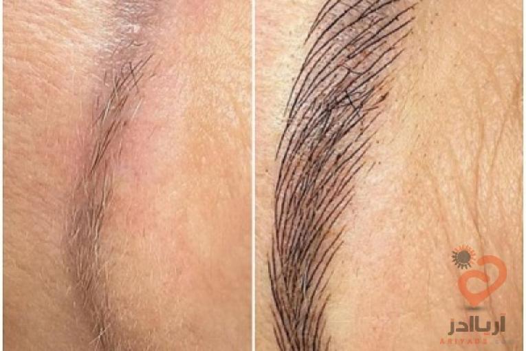 :: میکروبلیدینگ میکروپیگمنتیشن طراحی ابرو تاتو ابرو فیبروز ابرو کاشت مژه کاشت ناخن