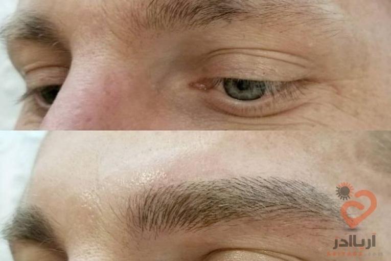 پرپشتی مو در یک جلسه با اسکالپ سر